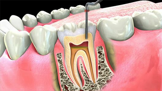Root Canal Procedure